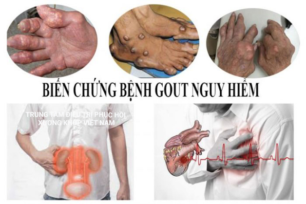 Biến chứng nguy hiểm bệnh Gout 