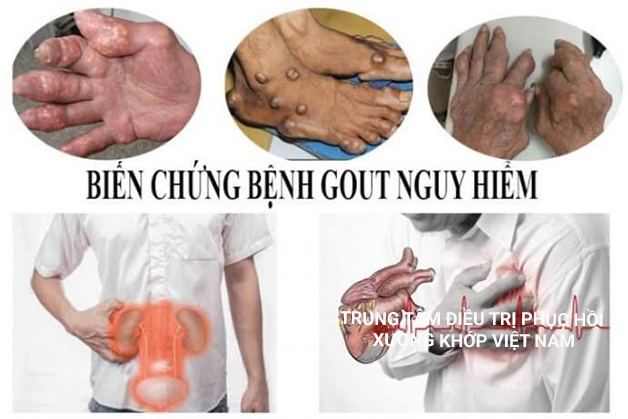 Biến chứng nguy hiểm của bệnh Gout