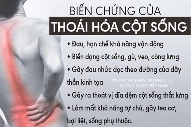 Biến chứng Thoái hóa cột sống