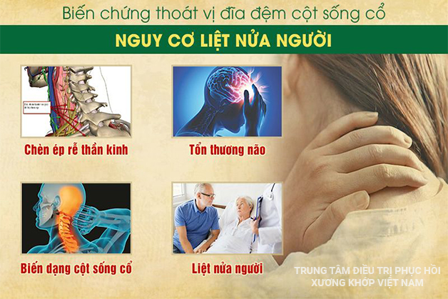 Biến chứng Thoát vị đĩa đệm