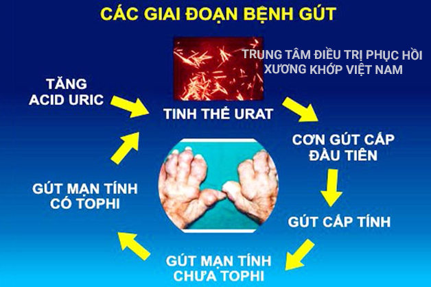 Các giai đoạn của bệnh Gout 