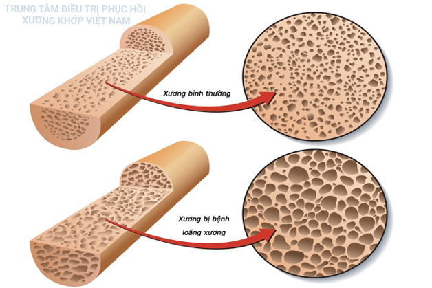 Canxi là thành phần quan trọng giúp xương chắc khỏe