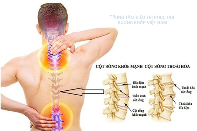 Cột sống khỏe mạnh, cột sống bị thoái hóa