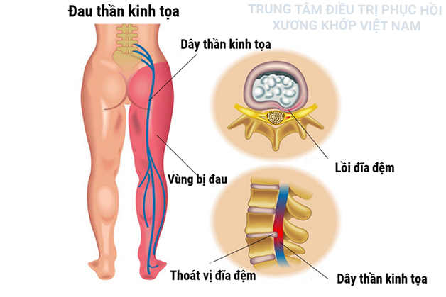 Đau dây thần kinh tọa