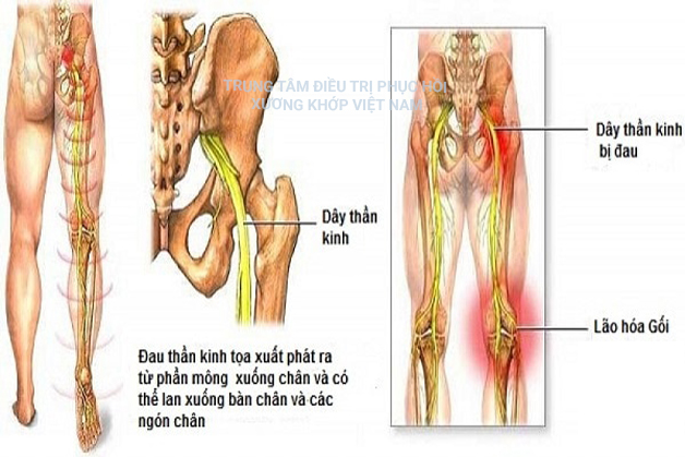 Dây thần kinh đau, lão hóa gối 