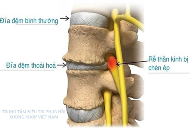 Đĩa đệm thoái hóa 