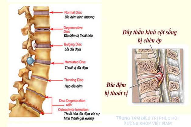 Đĩa đệm bị thoát vị 