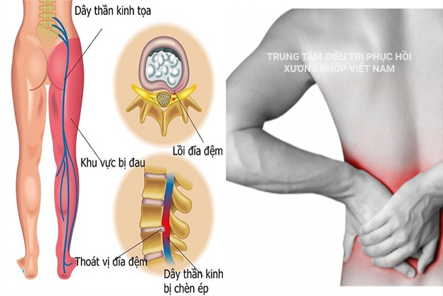 Đĩa đệm bị thoát vị