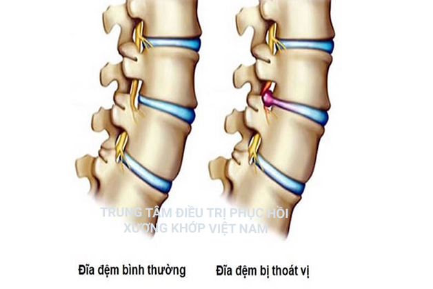 Đĩa đệm bình thường và đĩa đệm thoát vị 