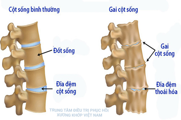 Bệnh gai cột sống 