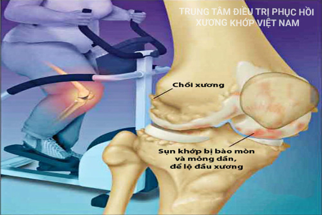 Đối tượng thừa cân, béo phì cũng dễ gặp nhiều hơn vì làm tăng nguy cơ