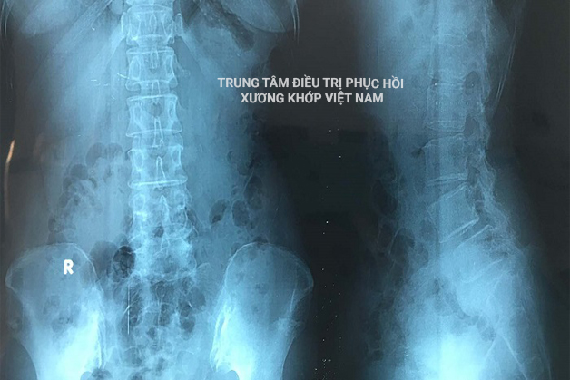 Hình ảnh X Quang