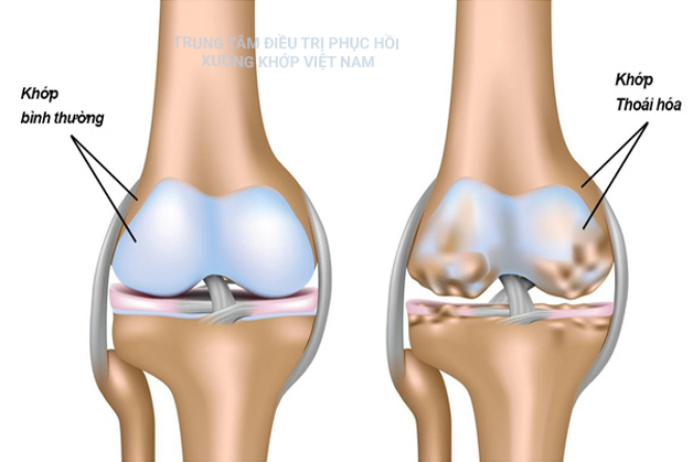 Khớp bình thường, khớp thoái hóa