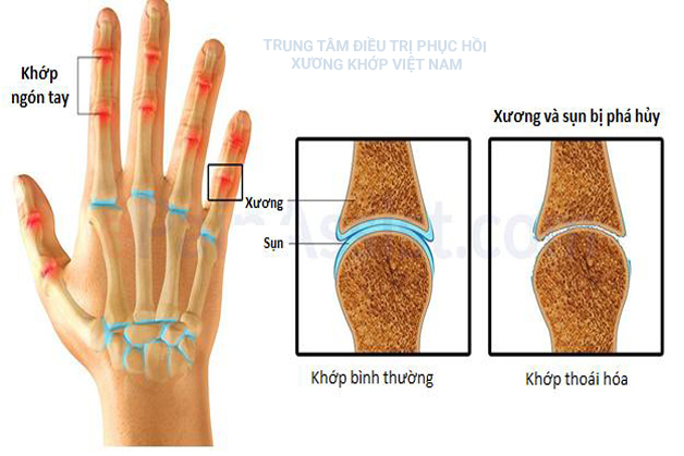 Khớp bình thường, khớp thoái hóa