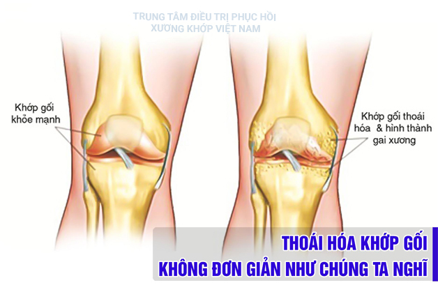 Khớp gối bình thường và khớp gối thoái hóa