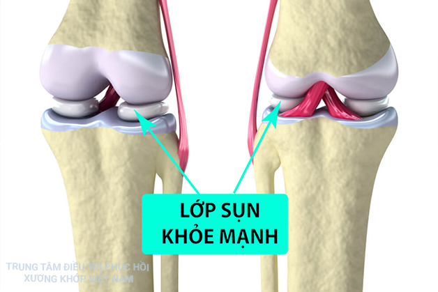 Lớp sụn khỏe mạnh 