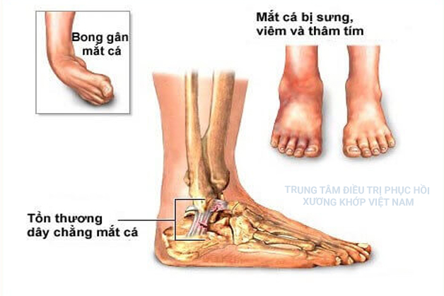 Một số nguyên nhân dẫn đến đau cổ chân