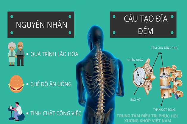 Nguyên nhân dẫn đến bệnh Thoát vị đĩa đệm