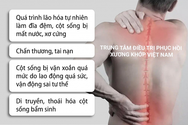 Nguyên nhân gây đau do thoát vị đĩa đệm