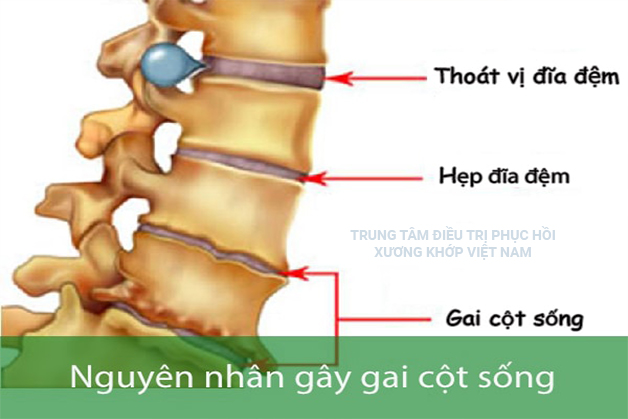 Nguyên nhân gây Gai cột sống