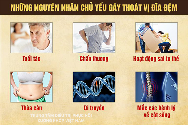 Nguyên nhân gây Thoát vị đĩa đệm L5S1