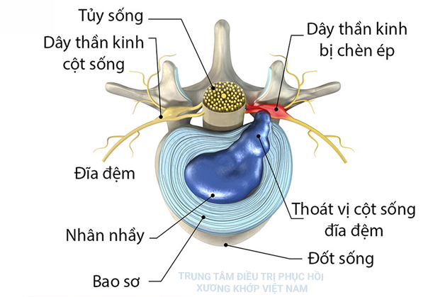 Bệnh Thoát vị đĩa đệm