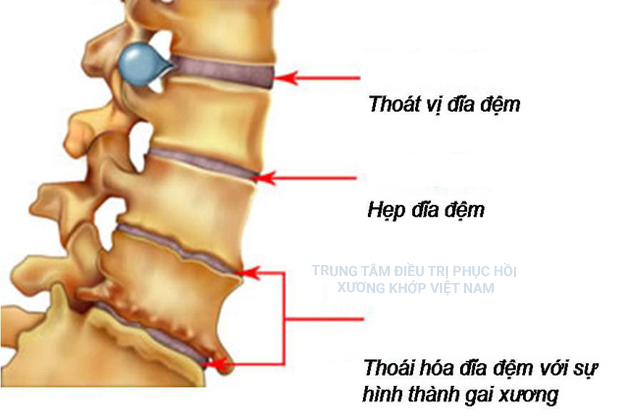  Thoái hóa đĩa đệm với sự hình thành gai xương