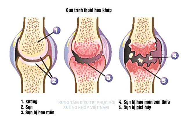 Thoái hóa khớp