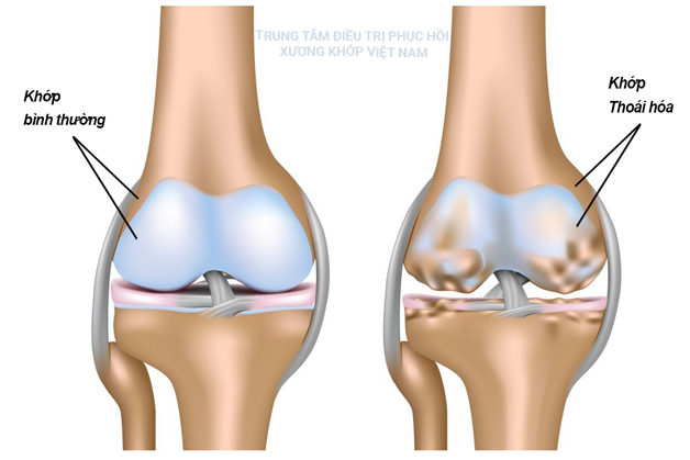 Thoái hóa khớp