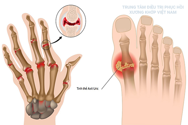 Các tinh thể Axit Uric