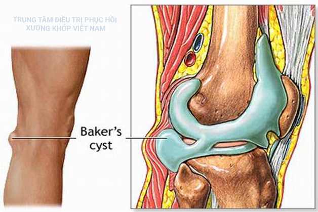 Tràn dịch khớp gối