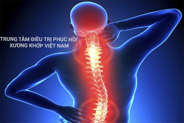 Triệu chứng Thoái hóa cột sống