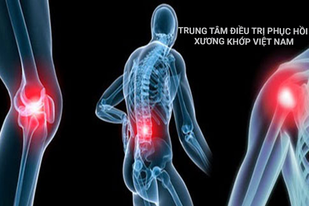 Triệu chứng Vôi hóa cột sống