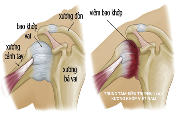 Viêm bao khớp