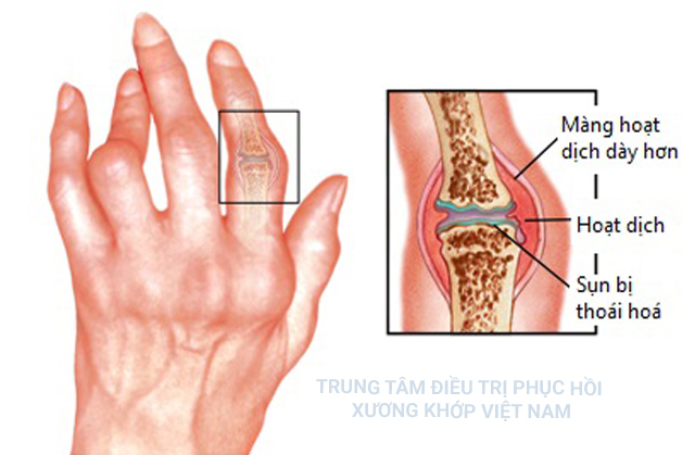 Viêm đa khớp dạng thấp 