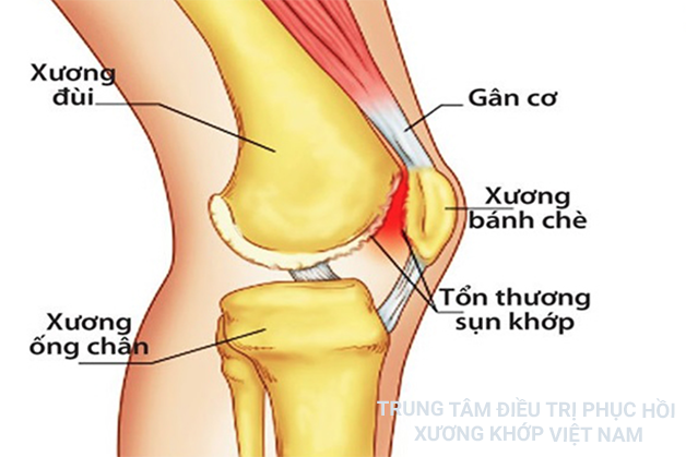 Viêm gân đầu gối 