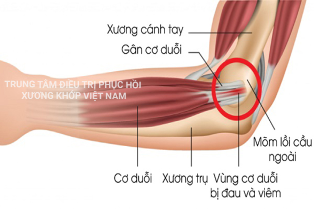 Viêm gân khuỷu tay 