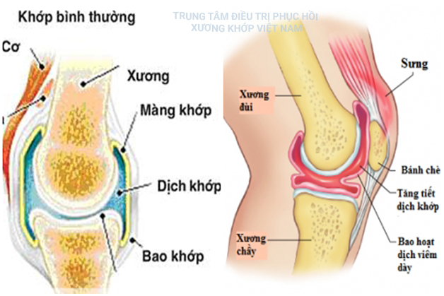 Viêm màng hoạt dịch khớp gối