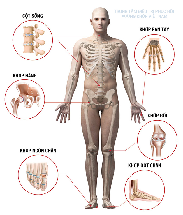 Việt Nam đang là một trong những nước phát triển với tỷ lệ người mắc bệnh xương khớp khá cao 