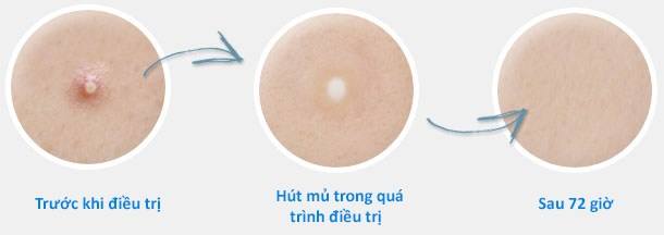 miếng dán che mụn