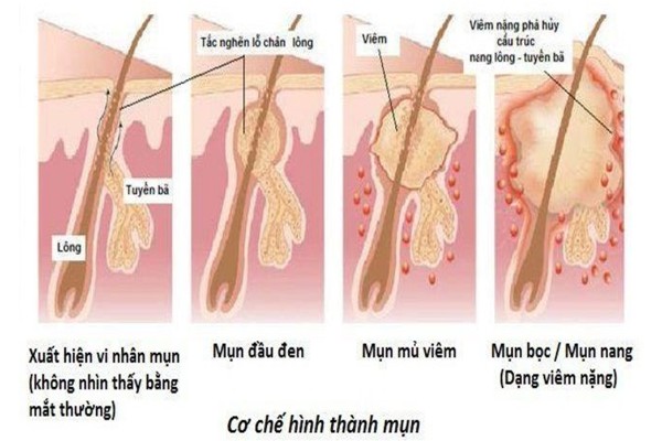 quá trình hình thành mụn