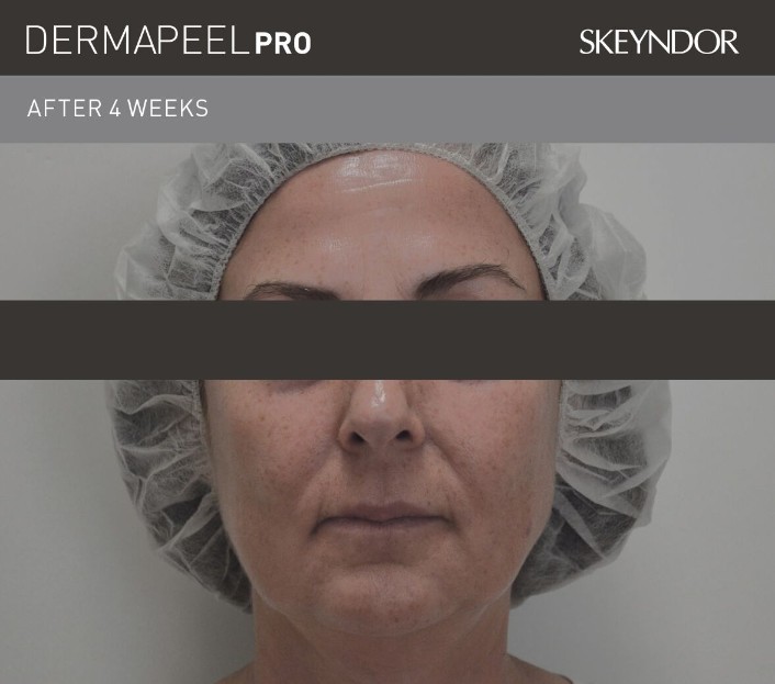 sau peel da derma peel