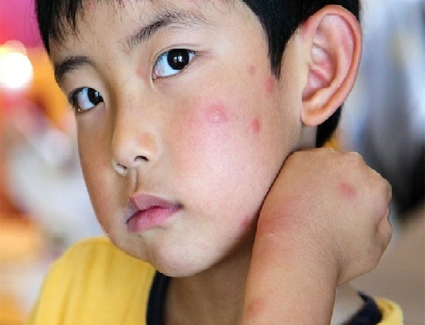 Dịch vụ diệt muỗi tại Hà Nội