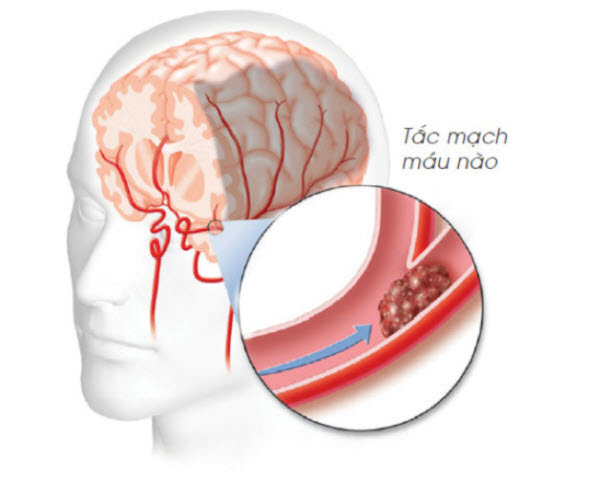 Phòng ngừa tai biến mạch máu não: Ngay hôm nay Phòng ngừa tai biến mạch máu não: Ngay hôm nay