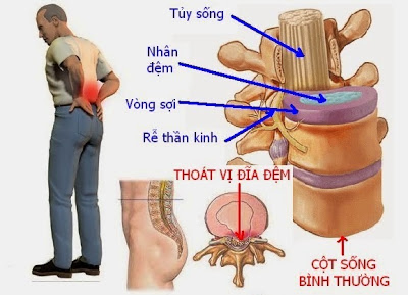 Thoát vị đĩa đệm cột sống thắt lưng là gì Thoát vị đĩa đệm cột sống thắt lưng là gì