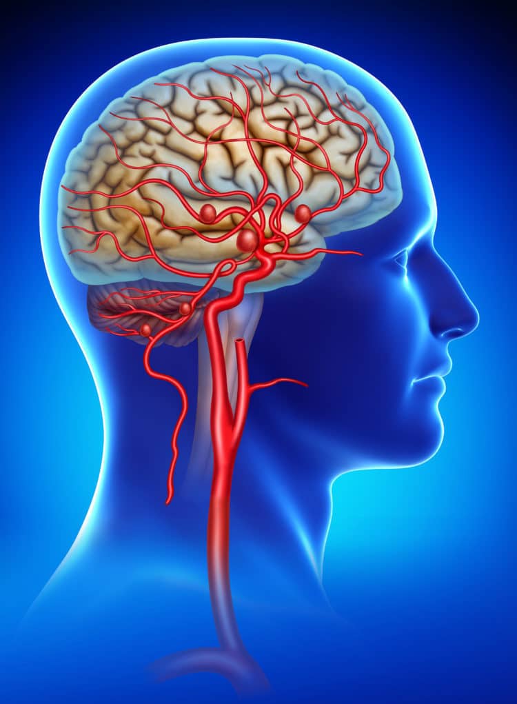 Bệnh phình động mạch máu não (aortic aneurysm)