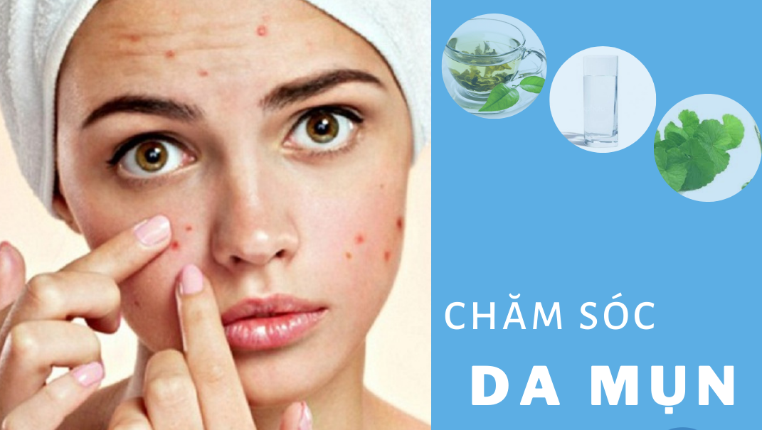 Mẹo ngừa mụn trứng cá cho da đơn giản với nước tinh khiết Mẹo ngừa mụn trứng cá cho da đơn giản với nước tinh khiết