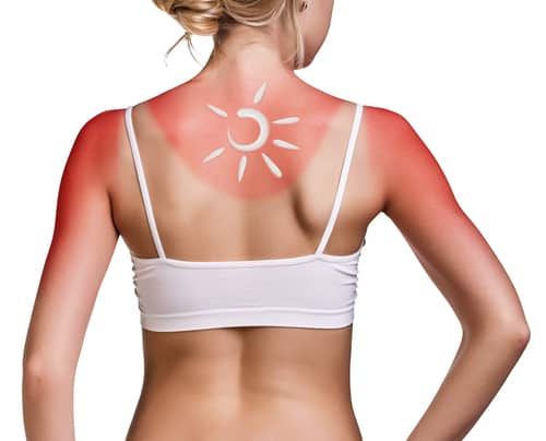 Một số lưu ý khi chữa da bị cháy nắng