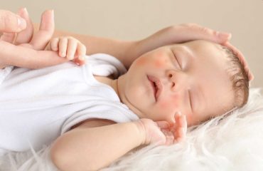 Chàm (eczema) – chẩn đoán và điều trị