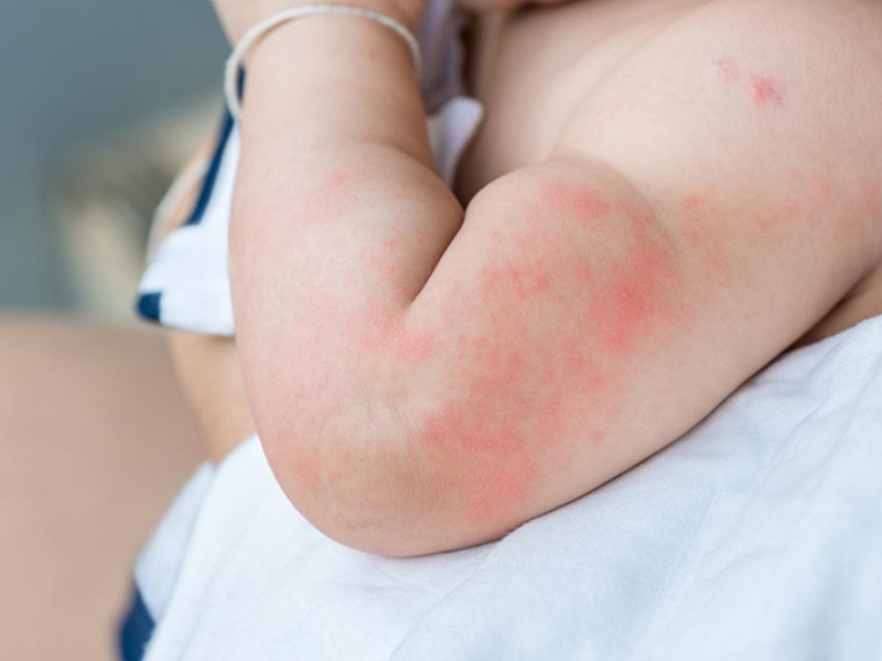 CÁC DẠNG VIÊM DA DỊ ỨNG Ở TRẺ NHỎ - CHA MẸ ĐỪNG LẦM TƯỞNG